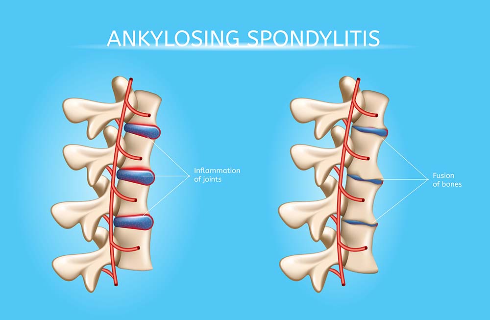 Ankylosing Spondylitis Infusion Therapy