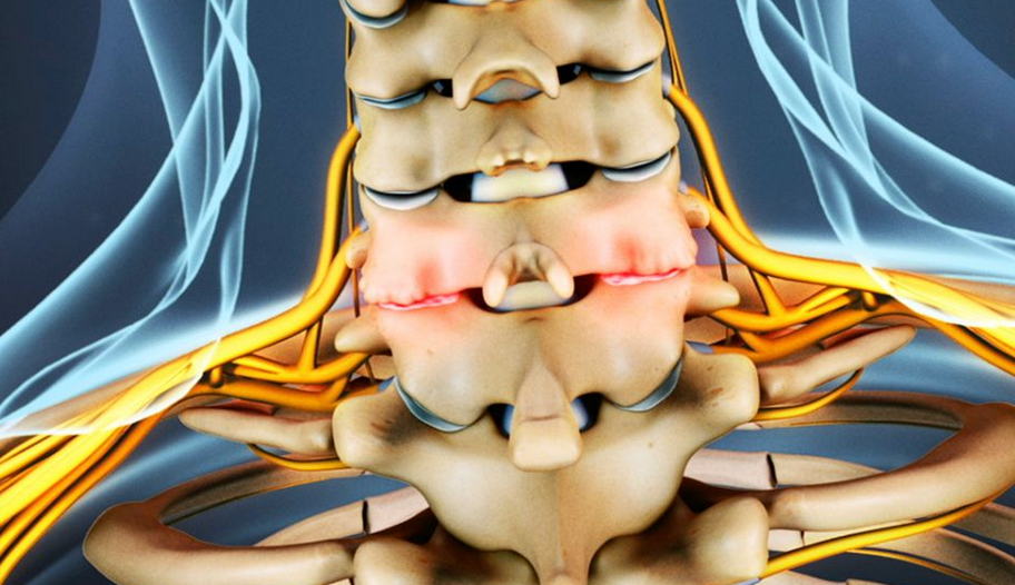 Neck Cracking: Can It Increase Your Risk of Having a Stroke?