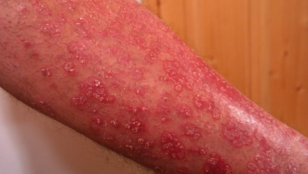 Psoriasis